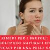 Rimedi per i Brufoli